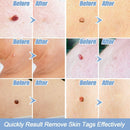 Painless Auto Mole Wart Skin Tag Removal Kit - WELLQHOME